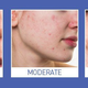Illustration for article titled Where To Have Chicago Laser Resurfacing Doneem/em
